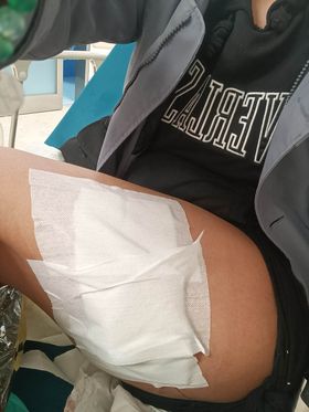 "In vacanza a Messina sono stata morsa da un cane randagio nella zona falcata"